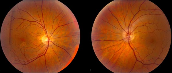 Fundus Photos showing optic disc edema