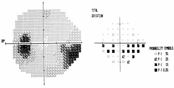 Figure 10. A similar inferior nasal nerve fiber bundle defect in an IIH patient found with automated perimeter (Humphrey perimeter). These defects may resolve fully with treatment. 