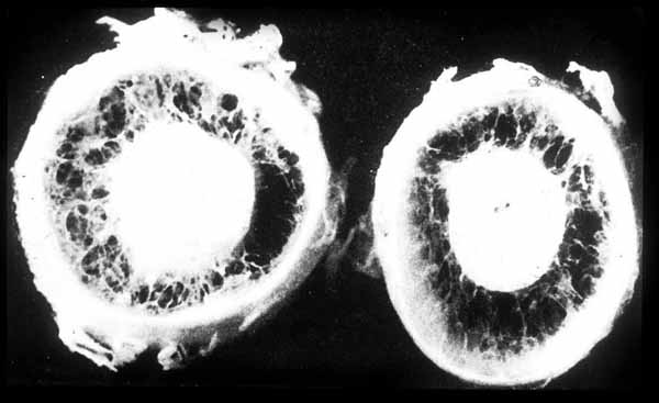 Figure 11. Cut sections of optic nerves (post-mortem) from a patient with papilledema. Note the large space, filled with the web-like strands of arachnoid between the nerve and the nerve sheath.With optic nerve sheath surgery, a hole is cut in the sheath of the nerve that allows fluid to leak and pressure to decrease