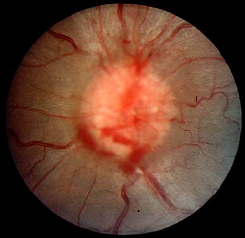 Grade IV papillededema. With more severe swelling in addition to a circumferential halo, the edema covers major blood vessels as they leave the optic disk (grade III) and vessels on the disk (grade IV).
A subretinal hemorrhage is present at 7 o'clock. 