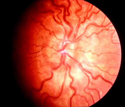 Pseudopapilledema. A patient with an elevated optic nerve present since birth. There is no halo, no major vessel covering a small nerve with abnormal vessel branching and tortuosity.