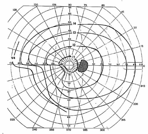 At typical visual field defect present using Goldmann perimetry in an IIH patient. Notice the large blind spot (black filled area) and the lower left indentation (an inferior nasal nerve fiber bundle defect). 