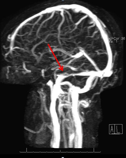 This figure shows is a magnetic resonance venogram showing veins draining the brain. 
The arrow points to a narrow transverse venous sinus likely responsible for pulsatile tinnitus.