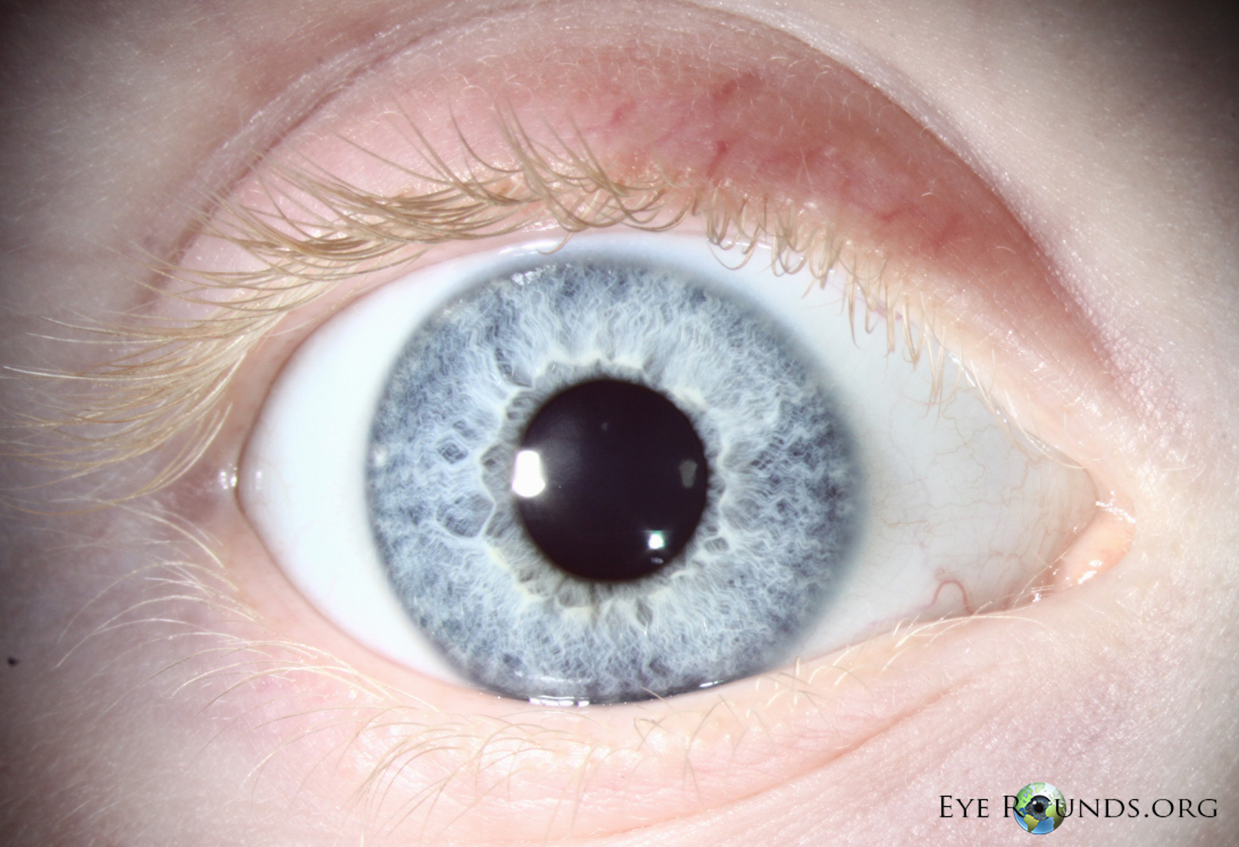 Atlas Entry - Oculocutaneous albinism