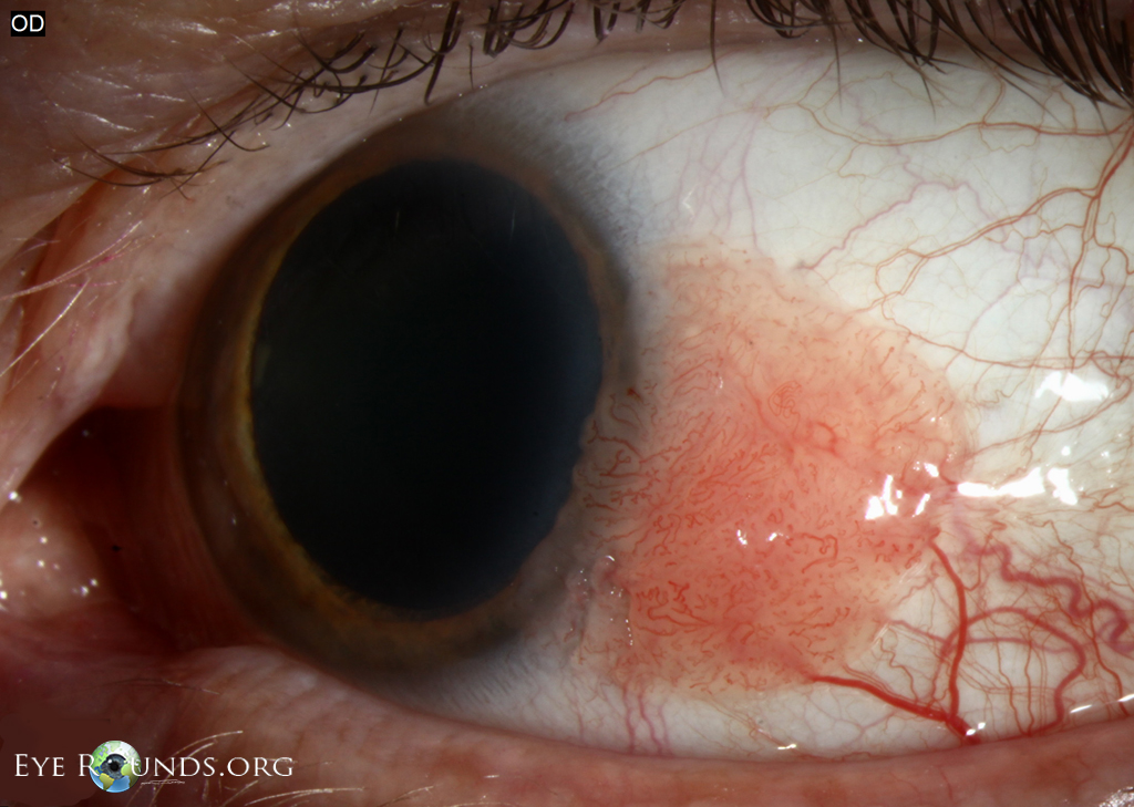 Atlas Entry Conjunctival squamous papilloma