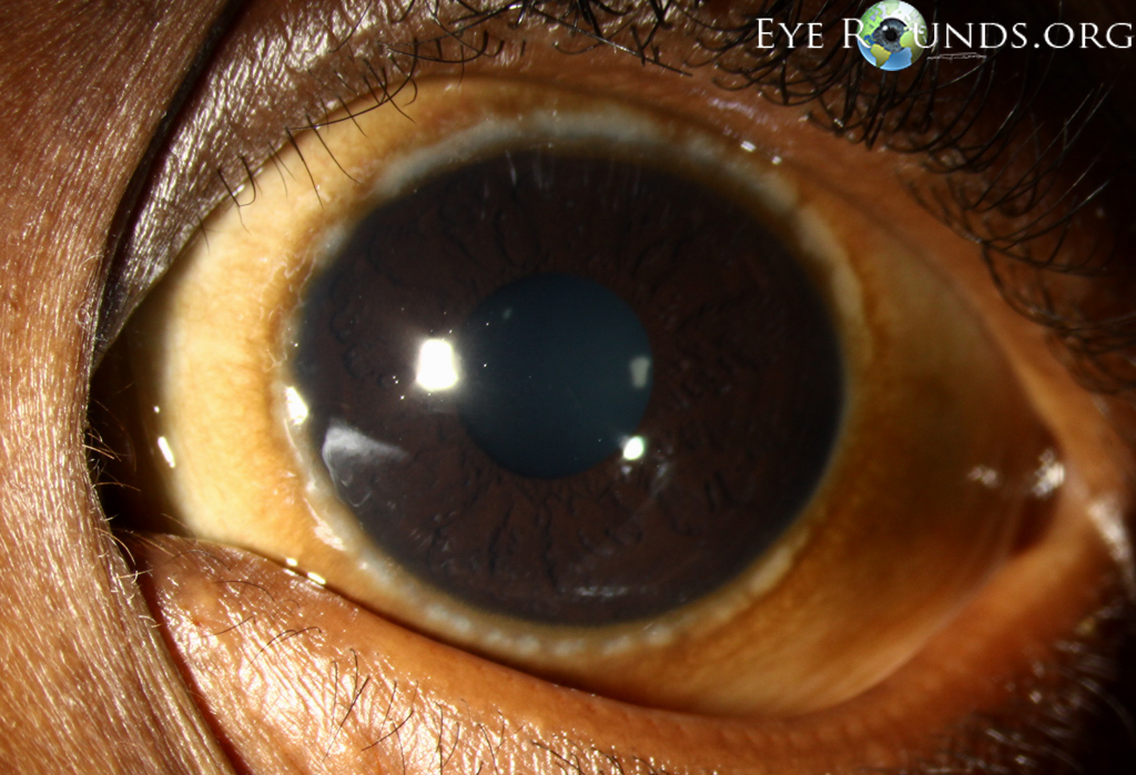 Vernal Keratoconjunctivitis. Online Ophthalmic Atlas