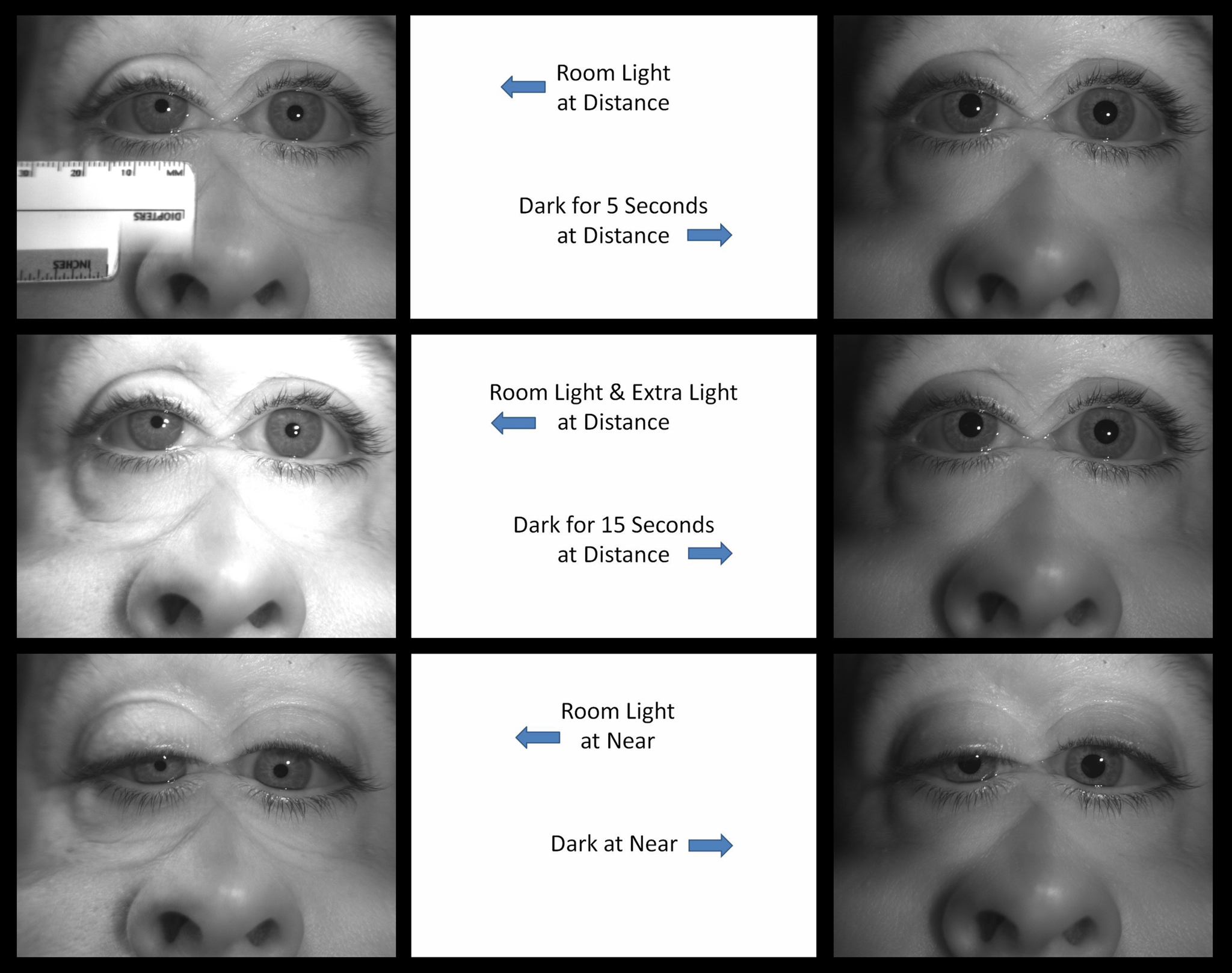Atlas Entry Apraclonidine Drop Testing for Horner Syndrome