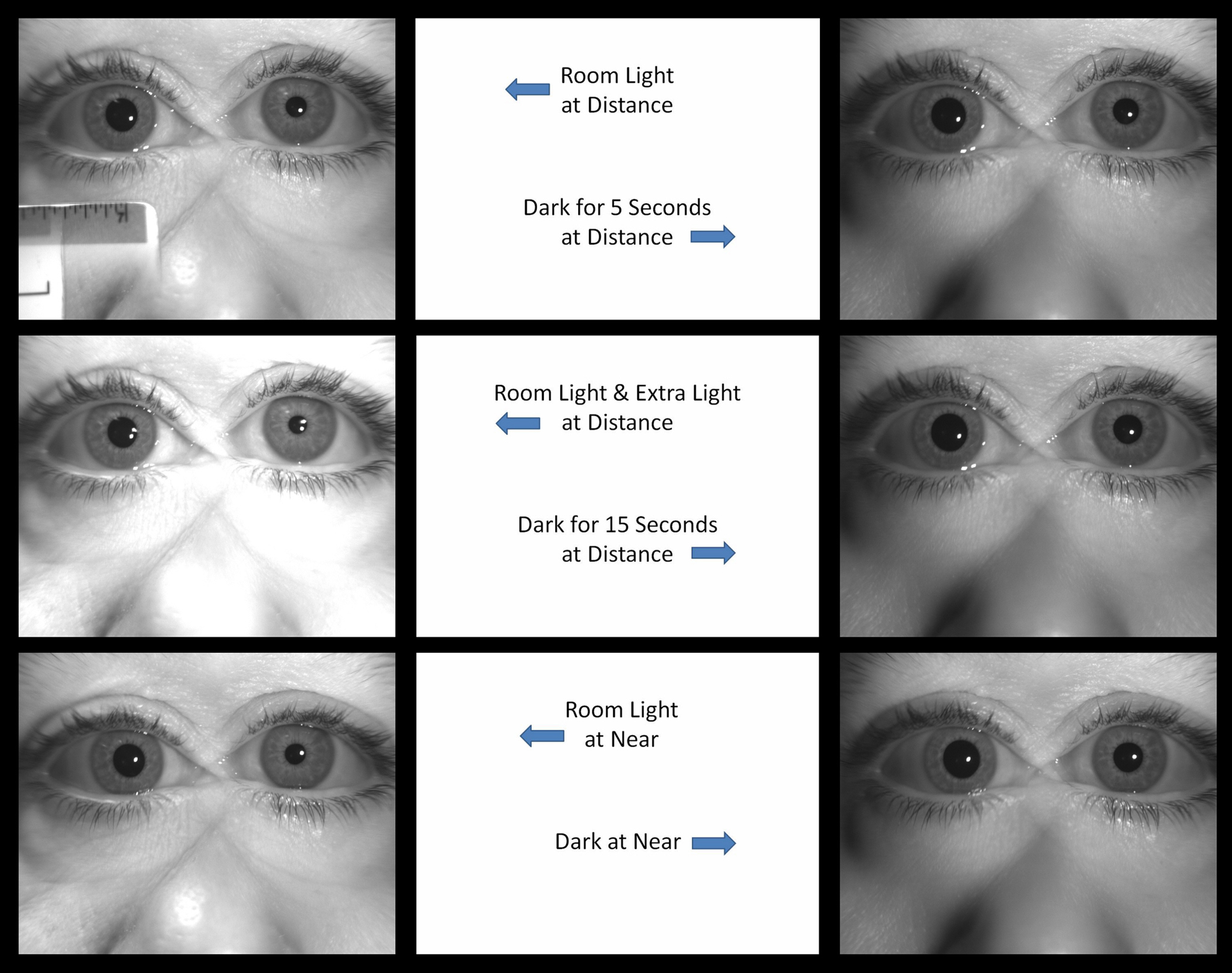 Atlas Entry Apraclonidine Drop Testing for Horner Syndrome