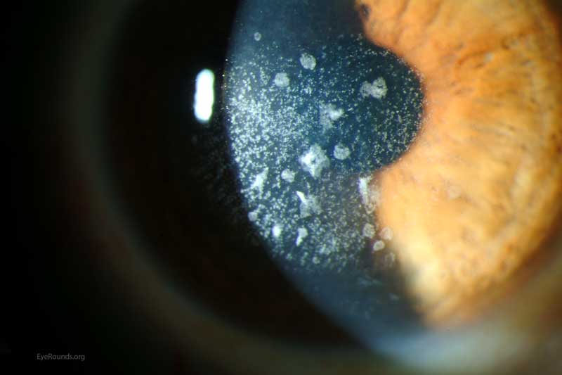 a closer look at the above with a slit lamp
