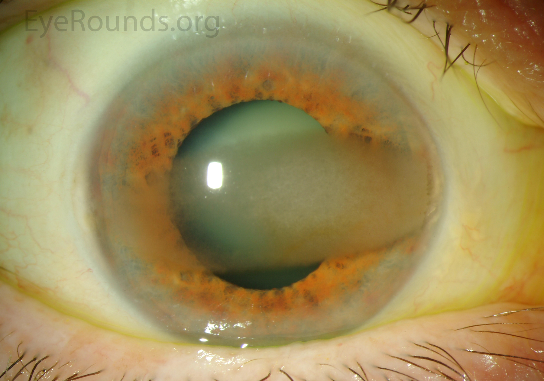 Atlas Entry Calcific band keratopathy