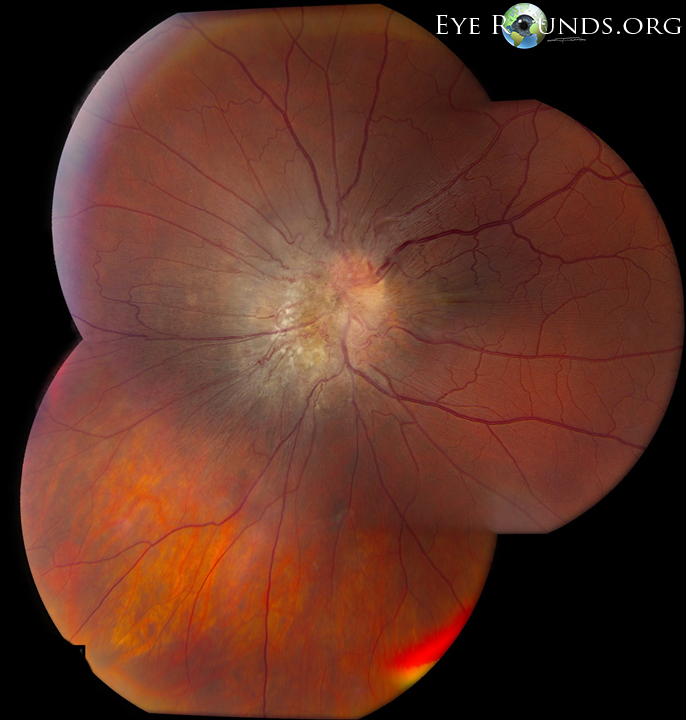 Atlas Entry Peripapillary Combined Hamartoma of the Retina and Retinal Pigment Epithelium