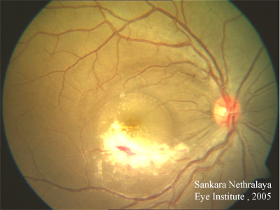 related case CMV Retinitis HIV