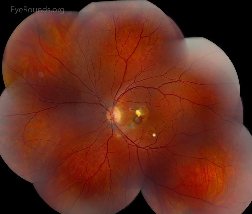 atlas-entry-choroidal-rupture-with-development-of-choroidal