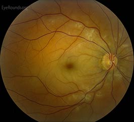 Central Retinal Artery Occlusion