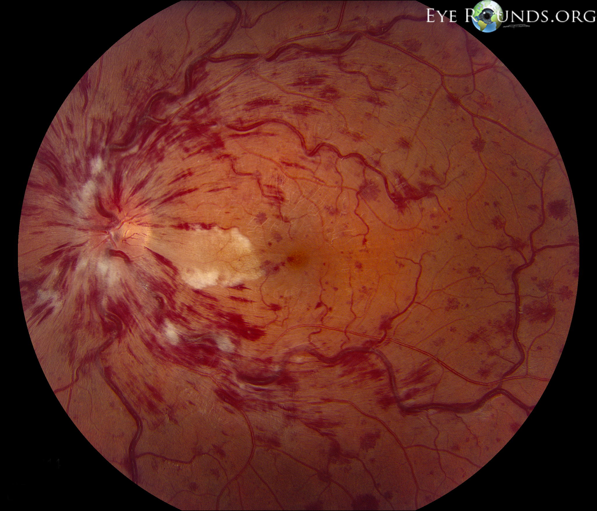 dot blot hemorrhages dot blot hemorrhages
