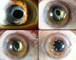 Anterior capsule phimosis