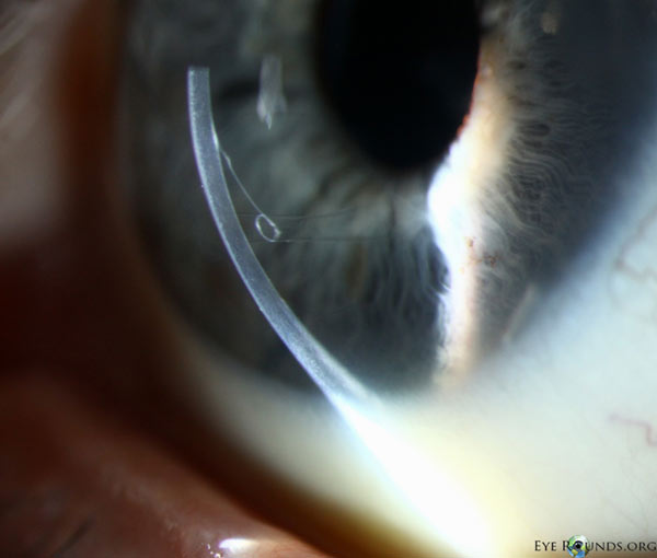 Chronic inferior edge lift of a DMEK graft. Notice the scrolling of the edge toward the stroma, indicating correct graft orientation, and the absence of stromal edema.