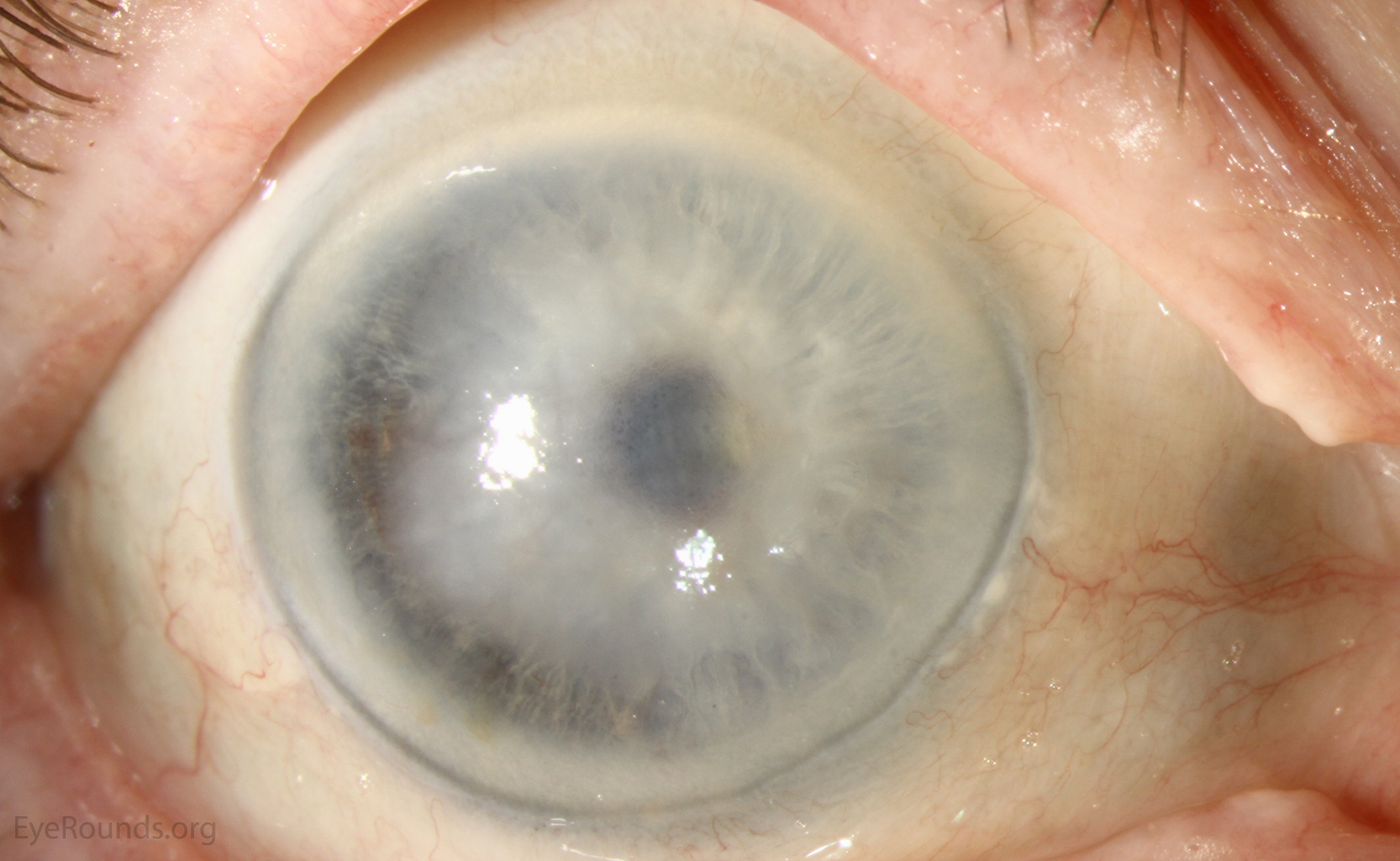 Atlas Entry Descemet membrane detachment after cataract extraction