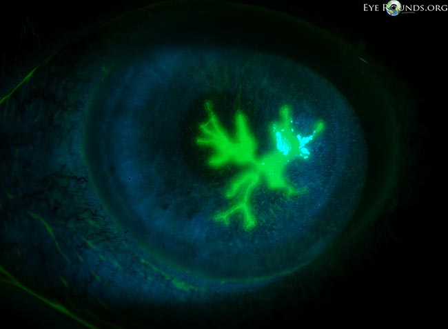hsv keratitis icd 10