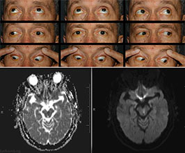 Internuclear ophthalmoplegia (INO)