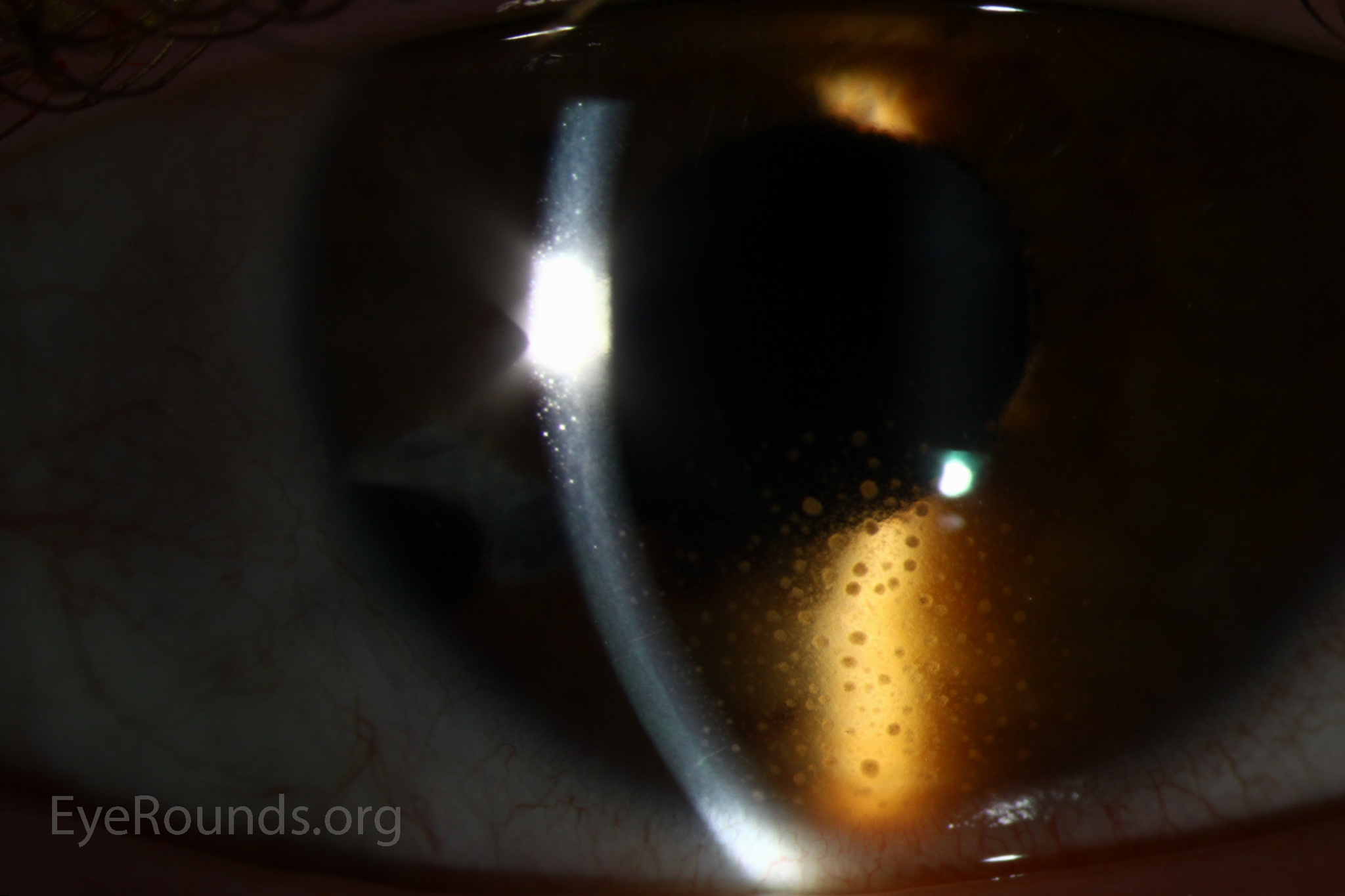 Atlas Entry Keratic precipitates (KP) in juvenile idiopathic