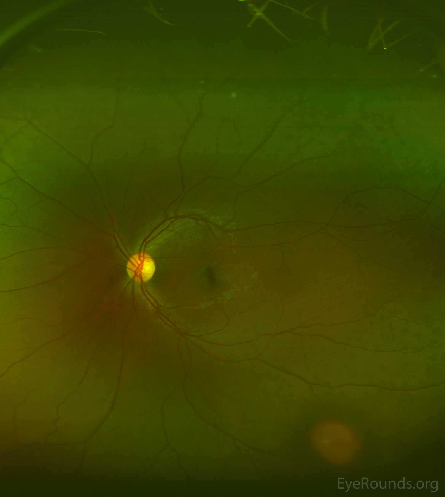Atlas Entry Nonproliferative sickle cell retinopathy