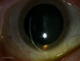 Pellucid marginal degeneration