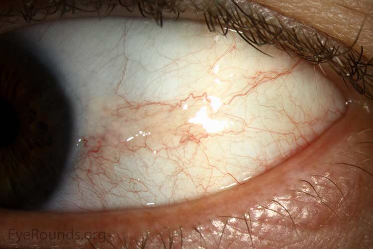 Red Bump In Corner Of Dog S Eye Red Bump In Corner Of Dog S Eye