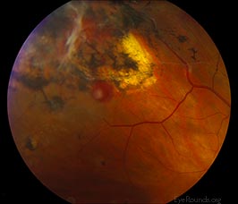 Retinal hemangioblastoma associated with Von-Hippel Lindau syndrome