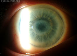 Schnyder Corneal Dystrophy