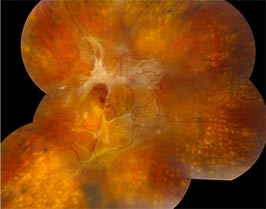 Severe Proliferative Diabetic Retinopathy