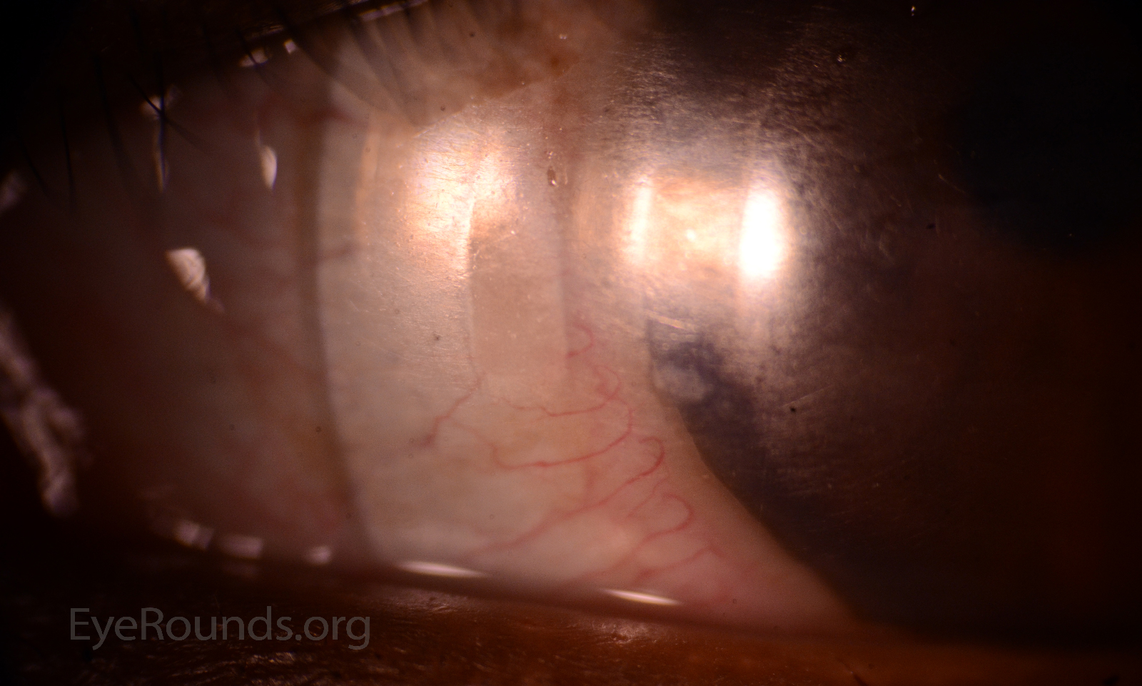 Atlas Entry Surface Coating Loss on Scleral Lens