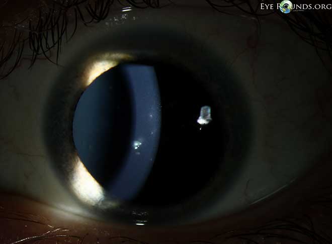 slit lamp view.  multiple slightly elevated corneal lesions which are round to oval conglomerates of gray, granular "crumblike" subepithelial opacities