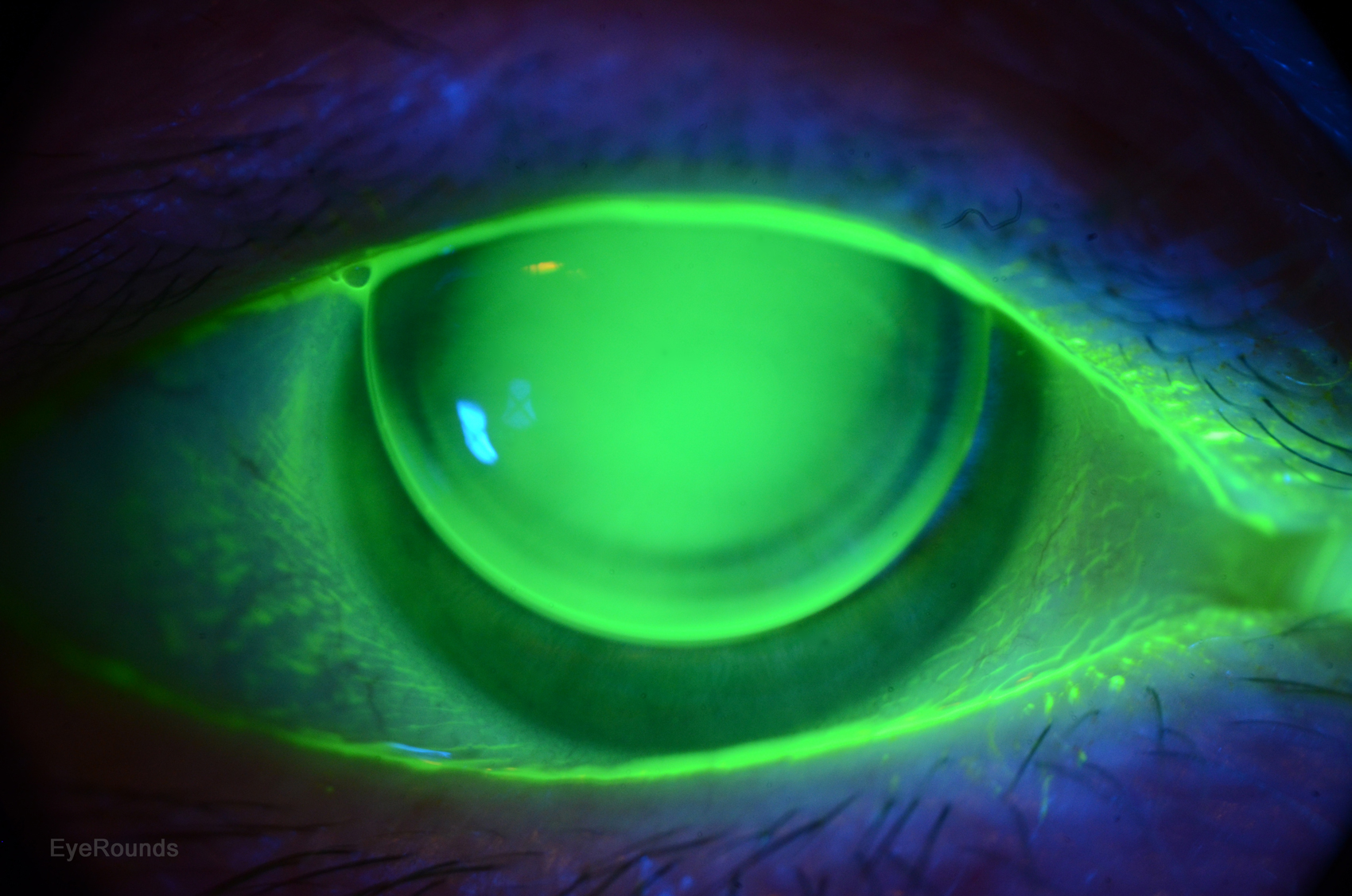 Rigid Gas Permeable (RGP) contact lens, good fit, cobalt blue,  yellow filter and fluorescein 