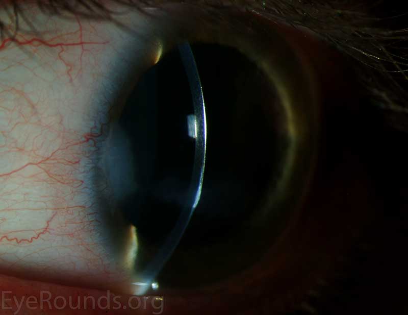 Band Keratopathy