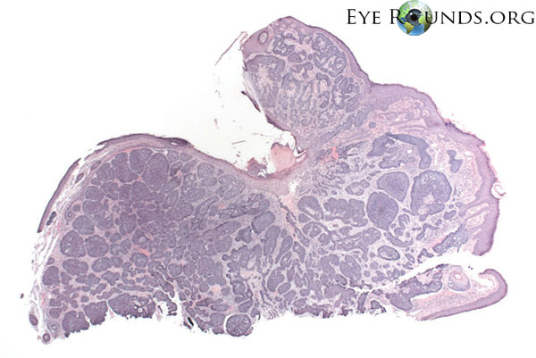 Nodular Basal Cell Carcinoma