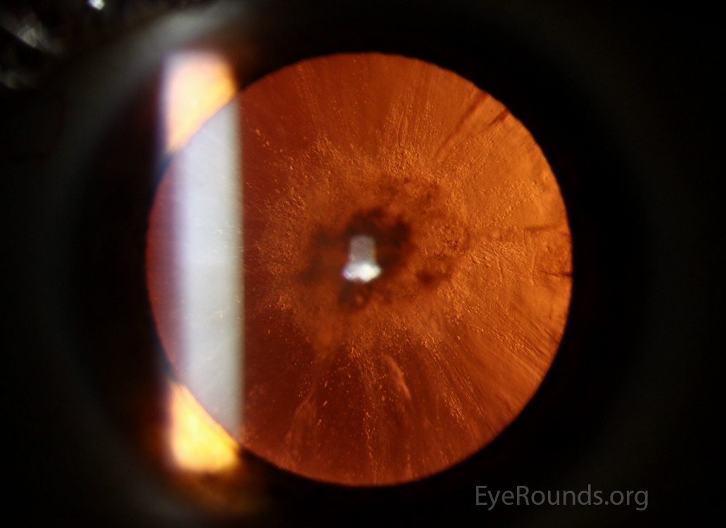 Combined Anterior Polar, Posterior Subcapsular and Cortical Cataract