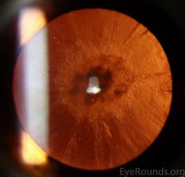 Combined Anterior Polar, Posterior Subcapsular and Cortical Cataract