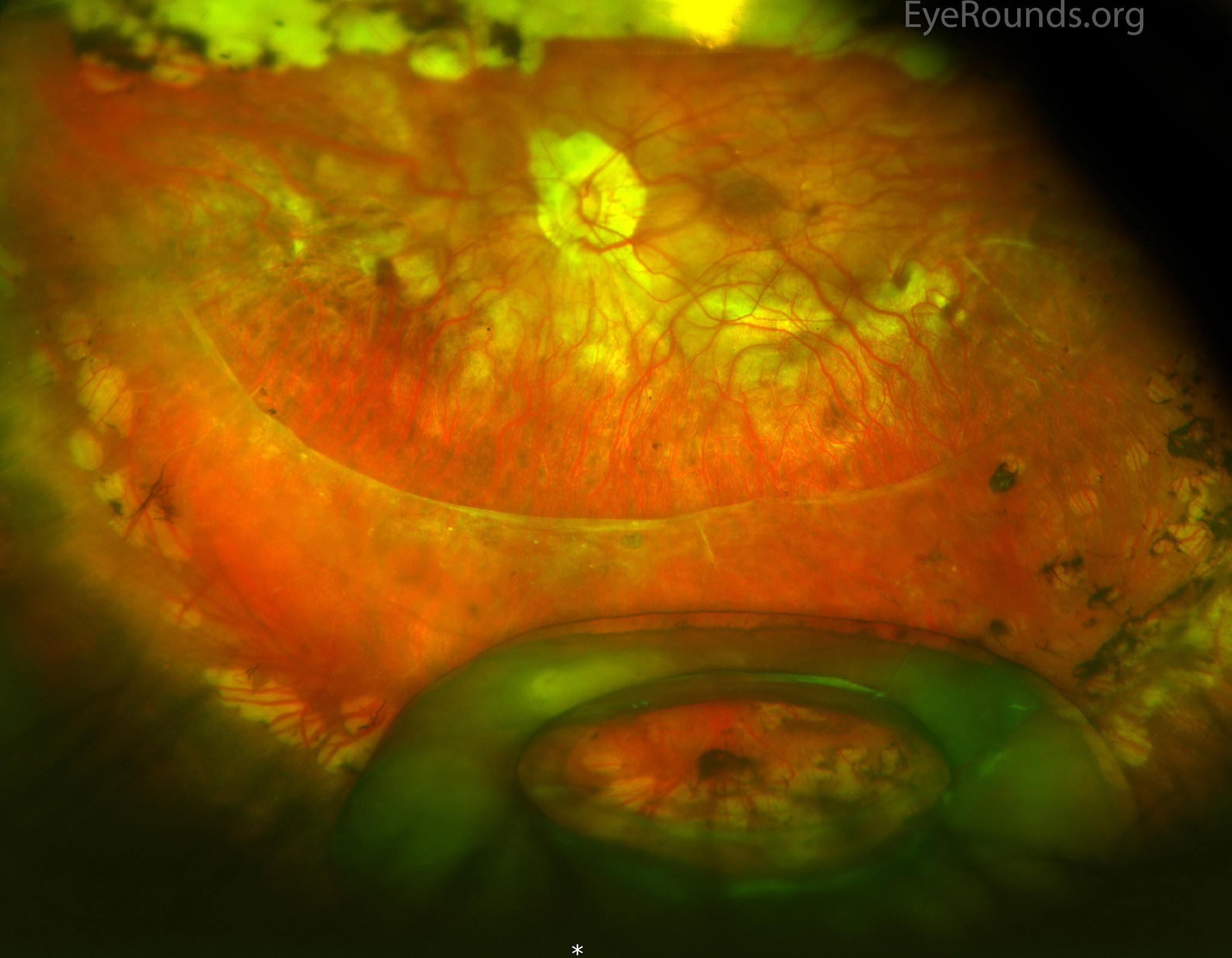 Atlas Entry Dislocated intraocular lens implant
