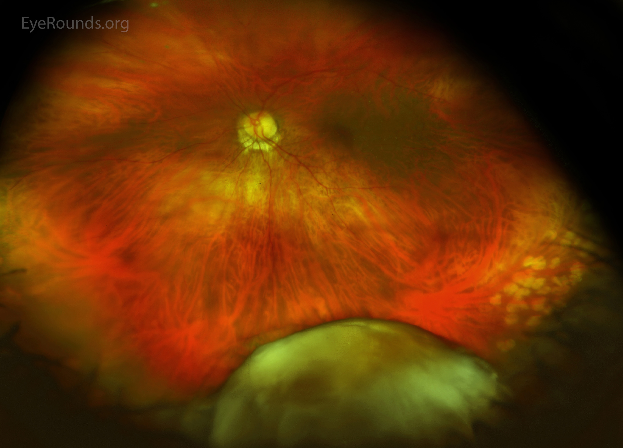 Atlas Entry Dislocated crystalline lens