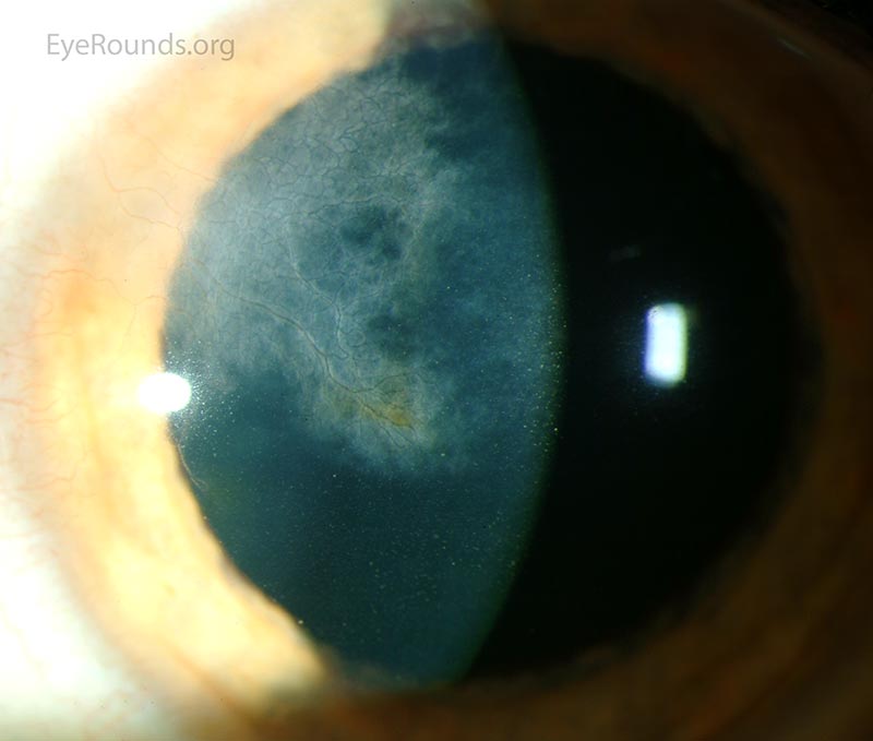 stromal scar in the left eye with regressed blood vessels ("ghost vessels")