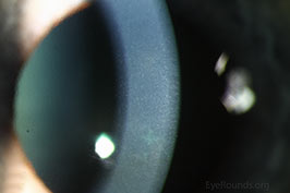 Guttae in Fuchs' endothelial corneal dystrophy
