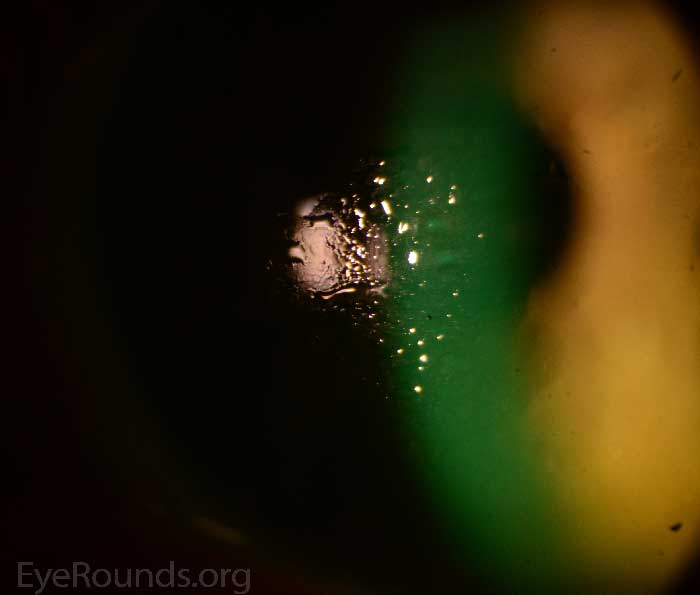 Atlas Entry Lipid Deposits on Scleral Rigid Gas Permeable (RGP) Lens