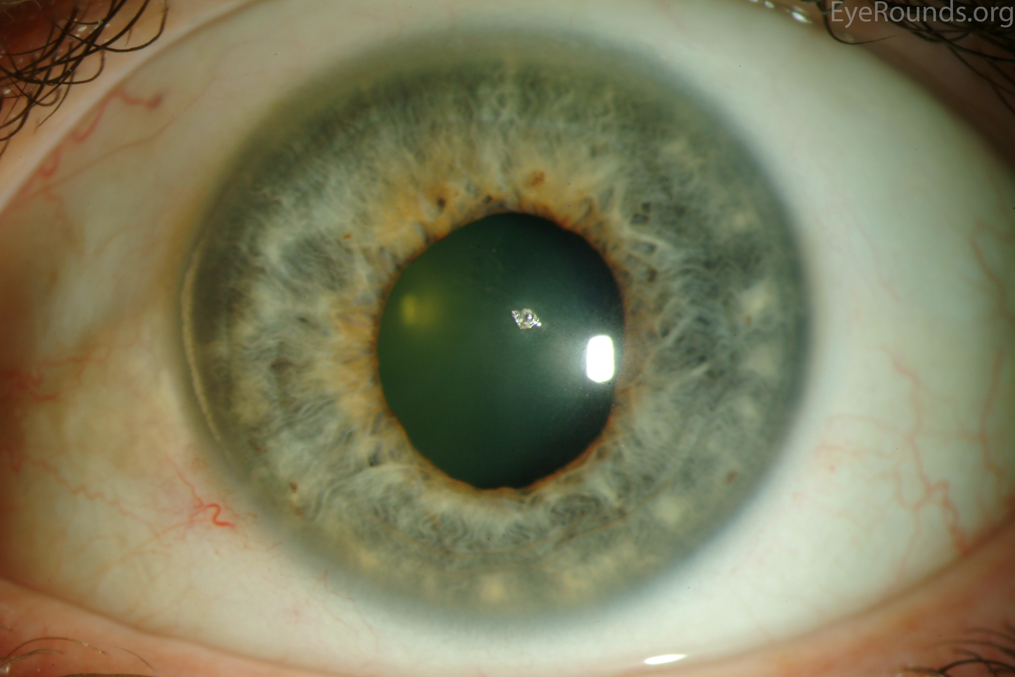 Atlas Entry Metallic corneal foreign body
