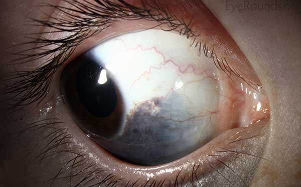 a slate grey discoloration of the sclera and eyelids, and variable amounts of iris and fundus hyperpigmentation