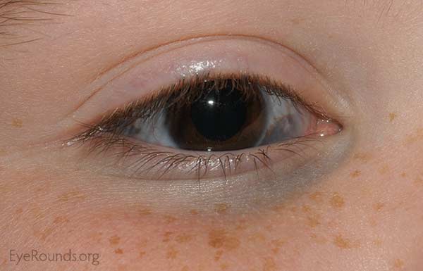 a slate grey discoloration of the sclera and eyelids, and variable amounts of iris and fundus hyperpigmentation