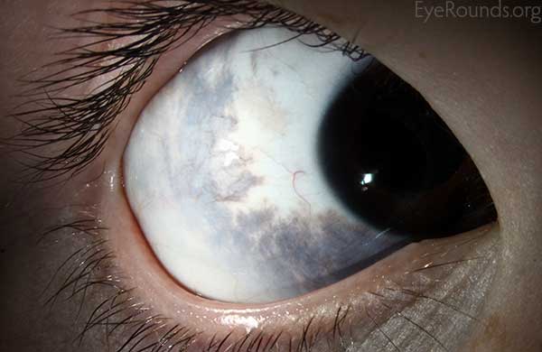 f excessive pigmentation of the uvea, sclera, episclera, and eyelids secondary to an increase in the number of normal melanocytes