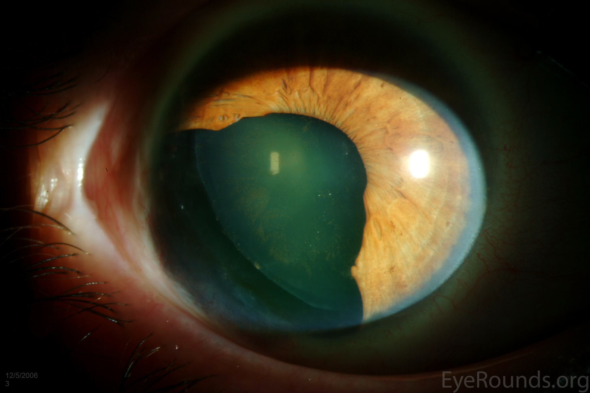 Atlas Entry Ophtec 311 iris reconstruction intraocular lens after