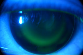 Orthokeratology