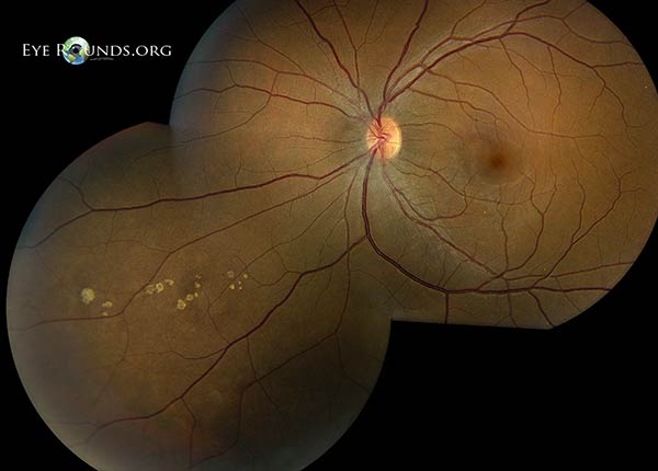icd 10 bear tracks retina